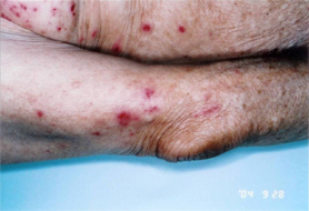 ダニ 疥癬 疥癬の症状と期間（疥癬どれくらいで治る？）